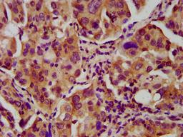 IHC image of CSB-PA324989LA01HU diluted at 1:600 and staining in paraffin-embedded human lung cancer performed on a Leica BondTM system. After dewaxing and hydration, antigen retrieval was mediated by high pressure in a citrate buffer (pH 6.0). Section was blocked with 10% normal goat serum 30min at RT. Then primary antibody (1% BSA) was incubated at 4&deg;C overnight. The primary is detected by a biotinylated secondary antibody and visualized using an HRP conjugated SP system.