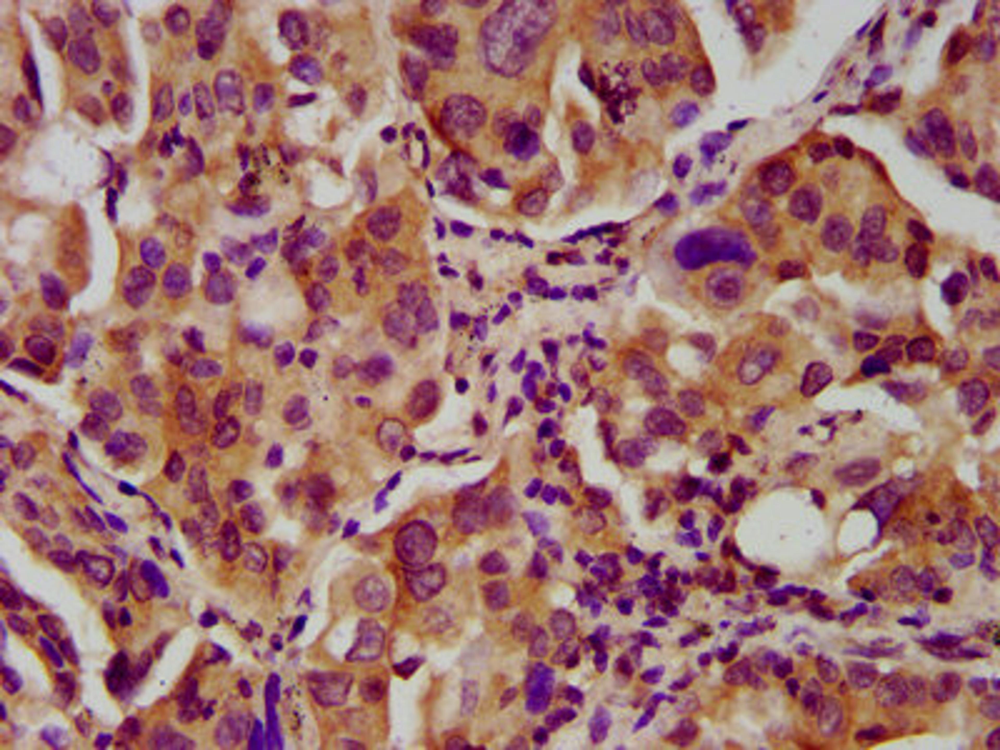 IHC image of CSB-PA324989LA01HU diluted at 1:600 and staining in paraffin-embedded human lung cancer performed on a Leica BondTM system. After dewaxing and hydration, antigen retrieval was mediated by high pressure in a citrate buffer (pH 6.0). Section was blocked with 10% normal goat serum 30min at RT. Then primary antibody (1% BSA) was incubated at 4&deg;C overnight. The primary is detected by a biotinylated secondary antibody and visualized using an HRP conjugated SP system.