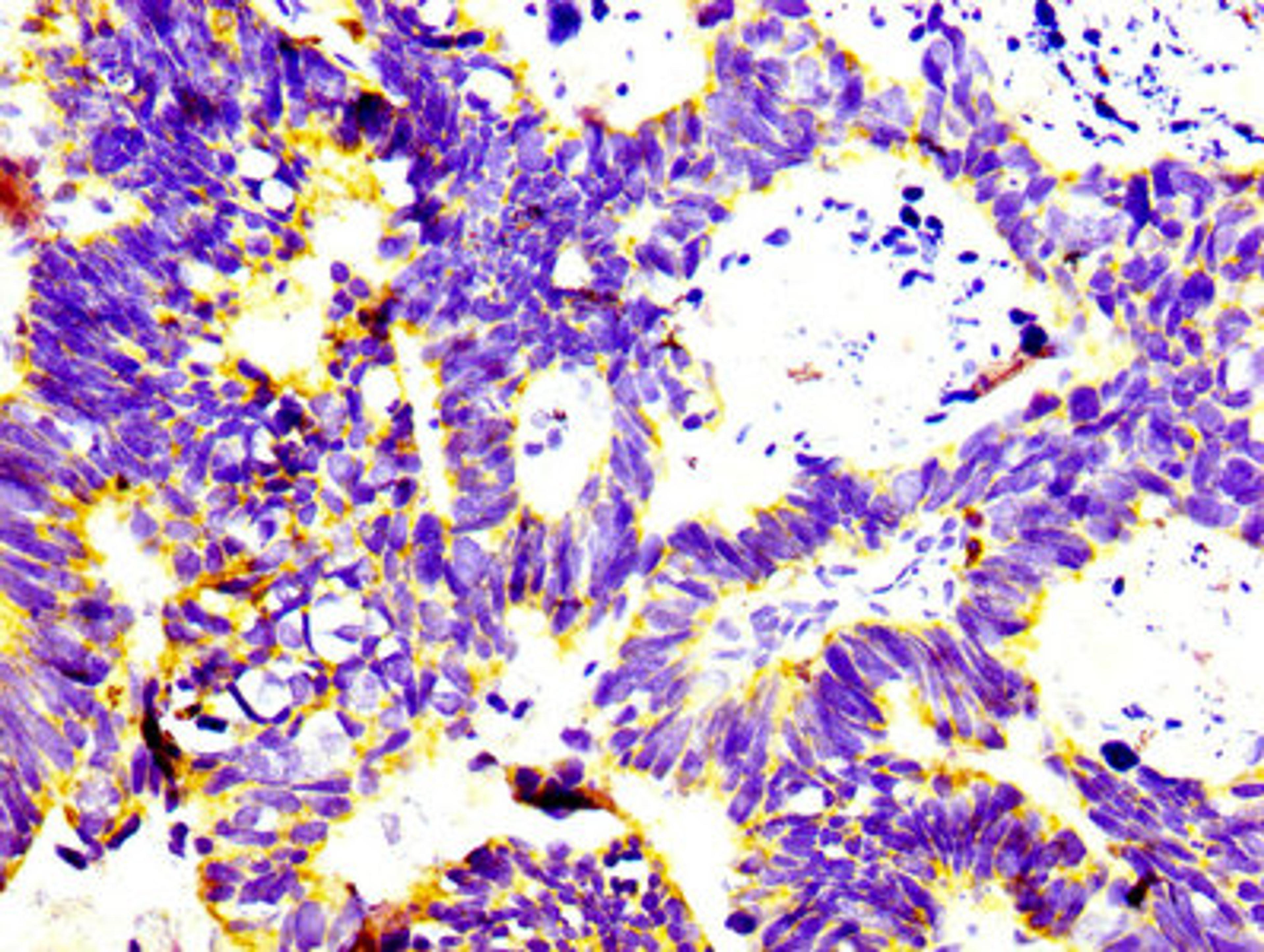 IHC image of CSB-RA004956A0HU diluted at 1:100 and staining in paraffin-embedded human ovarian cancer performed on a Leica BondTM system. After dewaxing and hydration, antigen retrieval was mediated by high pressure in a citrate buffer (pH 6.0). Section was blocked with 10% normal goat serum 30min at RT. Then primary antibody (1% BSA) was incubated at 4&deg;C overnight. The primary is detected by a biotinylated secondary antibody and visualized using an HRP conjugated SP system.