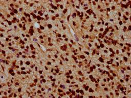 IHC image of CSB-PA010429OA91nacHU diluted at 1:5 and staining in paraffin-embedded human glioma performed on a Leica BondTM system. After dewaxing and hydration, antigen retrieval was mediated by high pressure in a citrate buffer (pH 6.0). Section was blocked with 10% normal goat serum 30min at RT. Then primary antibody (1% BSA) was incubated at 4&deg;C overnight. The primary is detected by a biotinylated secondary antibody and visualized using an HRP conjugated SP system.