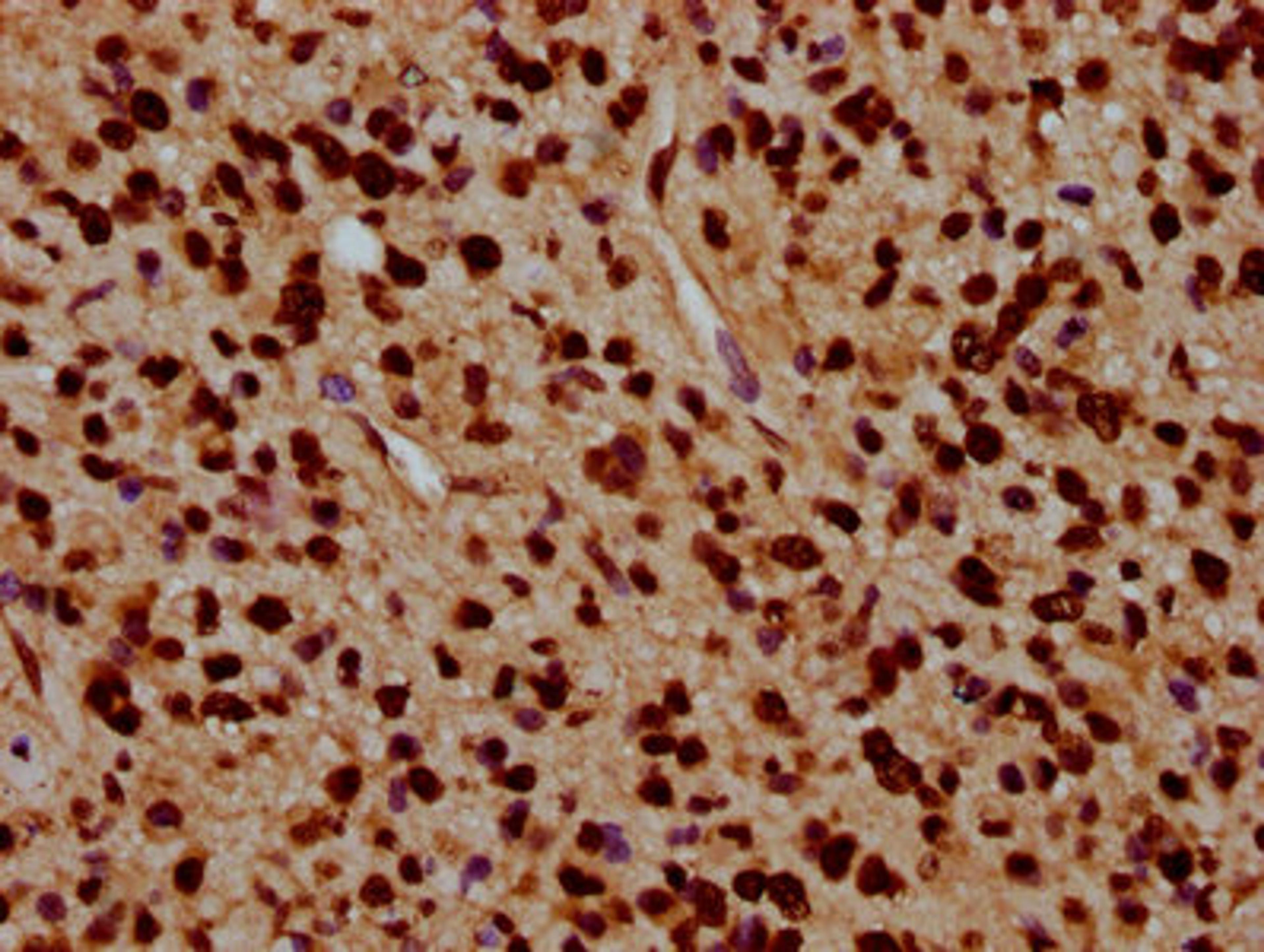 IHC image of CSB-PA010429OA91nacHU diluted at 1:5 and staining in paraffin-embedded human glioma performed on a Leica BondTM system. After dewaxing and hydration, antigen retrieval was mediated by high pressure in a citrate buffer (pH 6.0). Section was blocked with 10% normal goat serum 30min at RT. Then primary antibody (1% BSA) was incubated at 4&deg;C overnight. The primary is detected by a biotinylated secondary antibody and visualized using an HRP conjugated SP system.