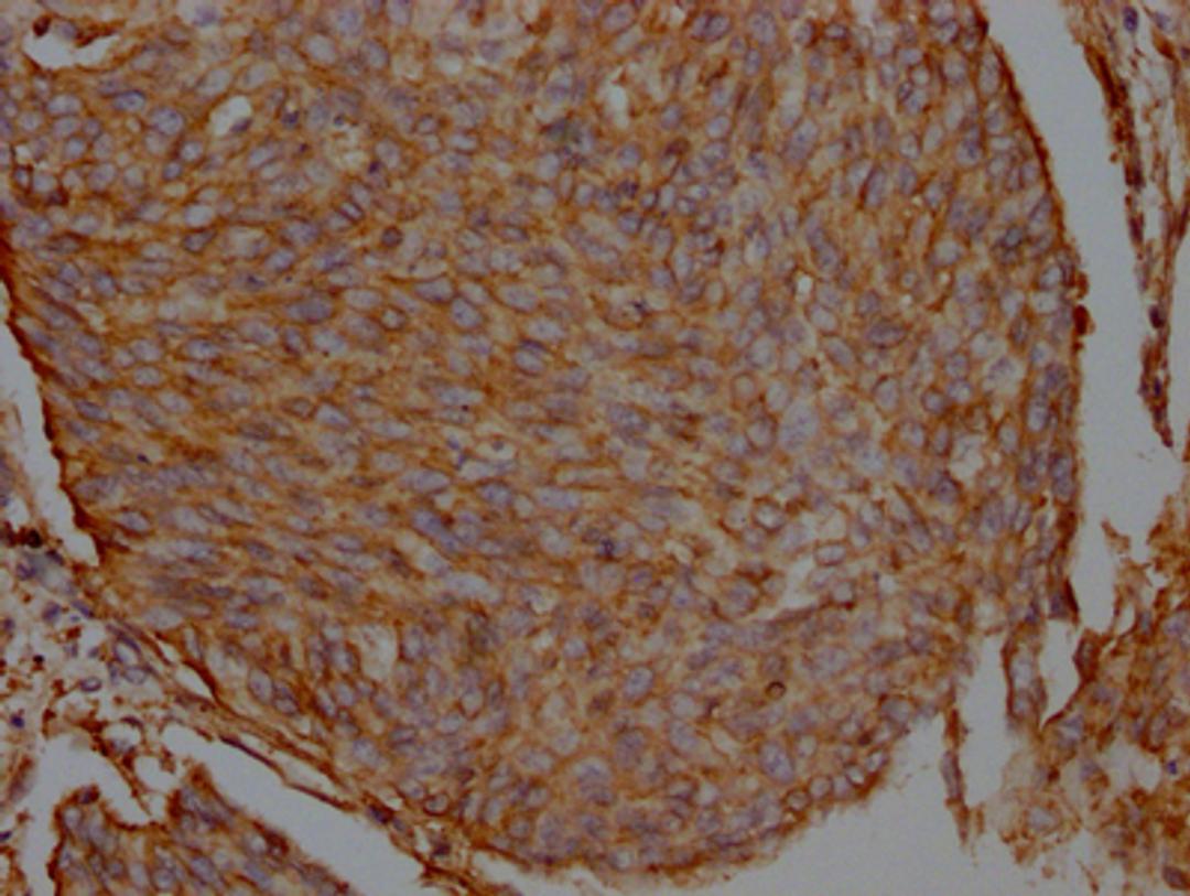 IHC image of CSB-RA548809A0HU diluted at 1:100 and staining in paraffin-embedded human cervical cancer performed on a Leica BondTM system. After dewaxing and hydration, antigen retrieval was mediated by high pressure in a citrate buffer (pH 6.0). Section was blocked with 10% normal goat serum 30min at RT. Then primary antibody (1% BSA) was incubated at 4℃ overnight. The primary is detected by a Goat anti-rabbit IgG polymer labeled by HRP and visualized using 0.05% DAB.