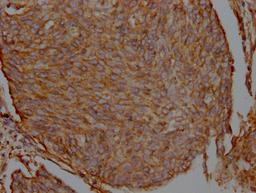 IHC image of CSB-RA548809A0HU diluted at 1:100 and staining in paraffin-embedded human cervical cancer performed on a Leica BondTM system. After dewaxing and hydration, antigen retrieval was mediated by high pressure in a citrate buffer (pH 6.0). Section was blocked with 10% normal goat serum 30min at RT. Then primary antibody (1% BSA) was incubated at 4℃ overnight. The primary is detected by a Goat anti-rabbit IgG polymer labeled by HRP and visualized using 0.05% DAB.