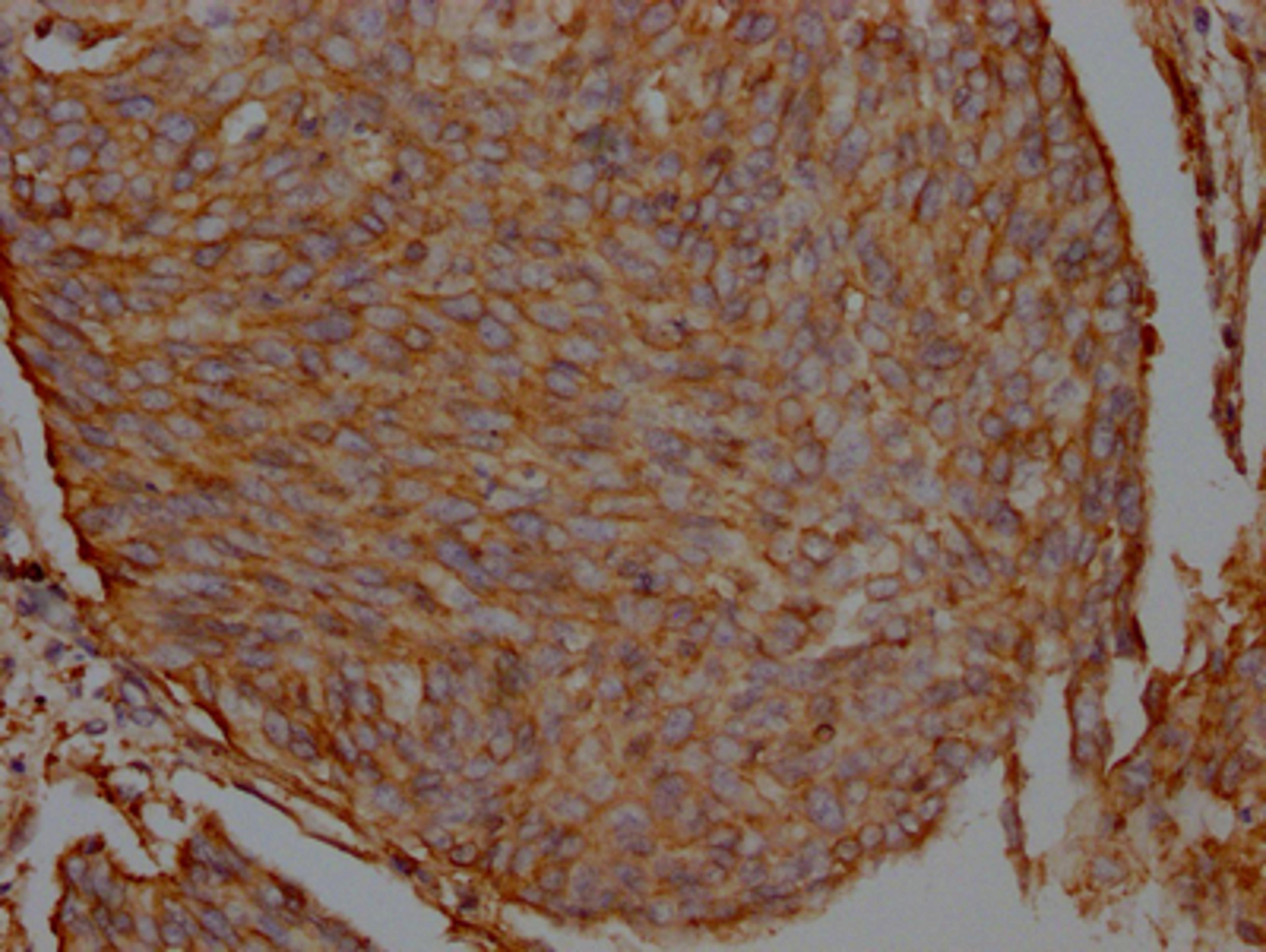IHC image of CSB-RA548809A0HU diluted at 1:100 and staining in paraffin-embedded human cervical cancer performed on a Leica BondTM system. After dewaxing and hydration, antigen retrieval was mediated by high pressure in a citrate buffer (pH 6.0). Section was blocked with 10% normal goat serum 30min at RT. Then primary antibody (1% BSA) was incubated at 4℃ overnight. The primary is detected by a Goat anti-rabbit IgG polymer labeled by HRP and visualized using 0.05% DAB.