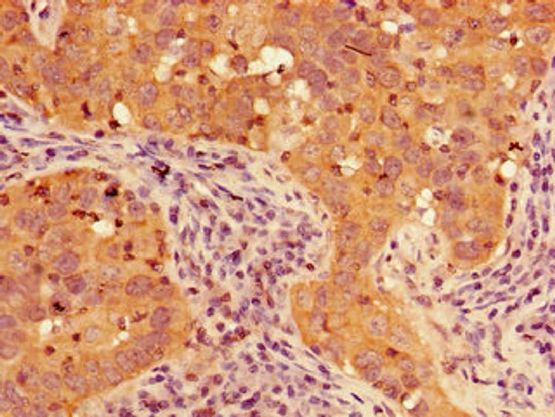Immunohistochemistry of paraffin-embedded human pancreatic cancer using CSB-PA889078LA01HU at dilution of 1:100