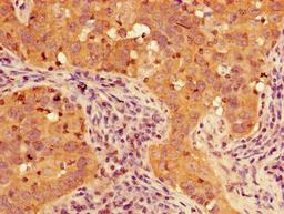 Immunohistochemistry of paraffin-embedded human pancreatic cancer using CSB-PA889078LA01HU at dilution of 1:100