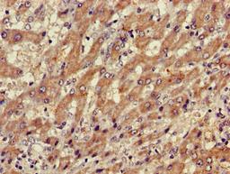 Immunohistochemistry of paraffin-embedded human liver cancer using CSB-PA05319A0Rb at dilution of 1:100