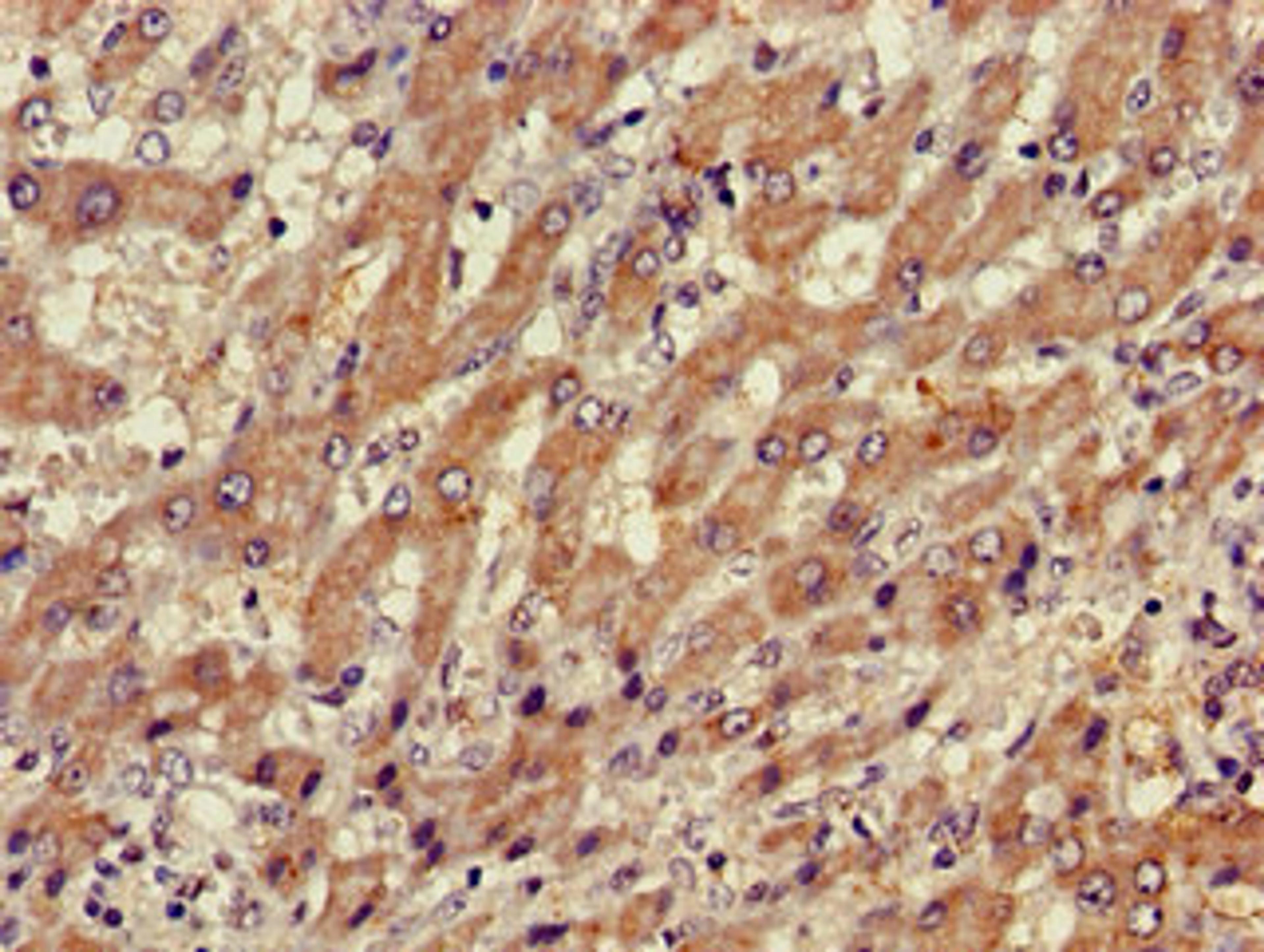 Immunohistochemistry of paraffin-embedded human liver cancer using CSB-PA05319A0Rb at dilution of 1:100
