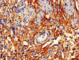 Immunohistochemistry of paraffin-embedded human bladder cancer using CSB-PA004947EA01HU at dilution of 1:100