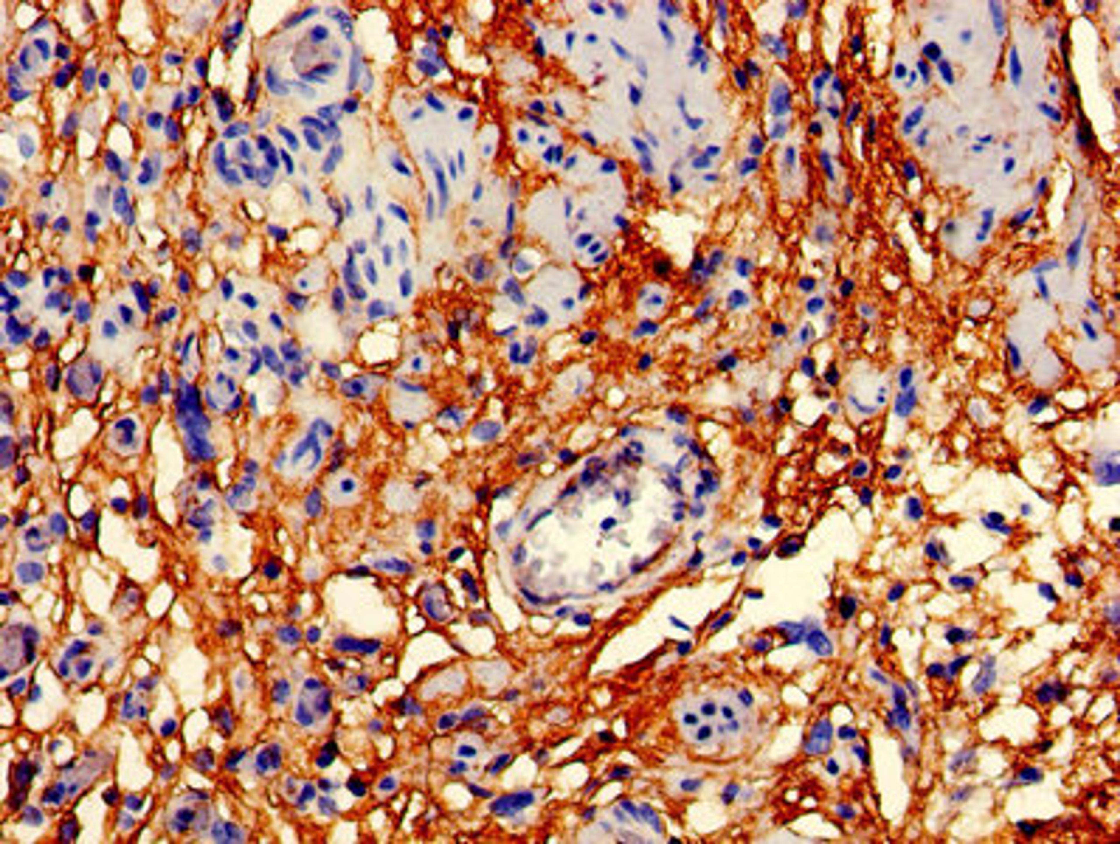 Immunohistochemistry of paraffin-embedded human bladder cancer using CSB-PA004947EA01HU at dilution of 1:100
