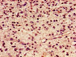 Immunohistochemistry of paraffin-embedded human glioma using CSB-PA010389PA119ncrHU at dilution of 1:100