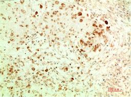 Immunohistochemical analysis of paraffin-embedded Human Ovarian Carcinoma Tissue using ATG5  Mouse mAb diluted at 1:200.