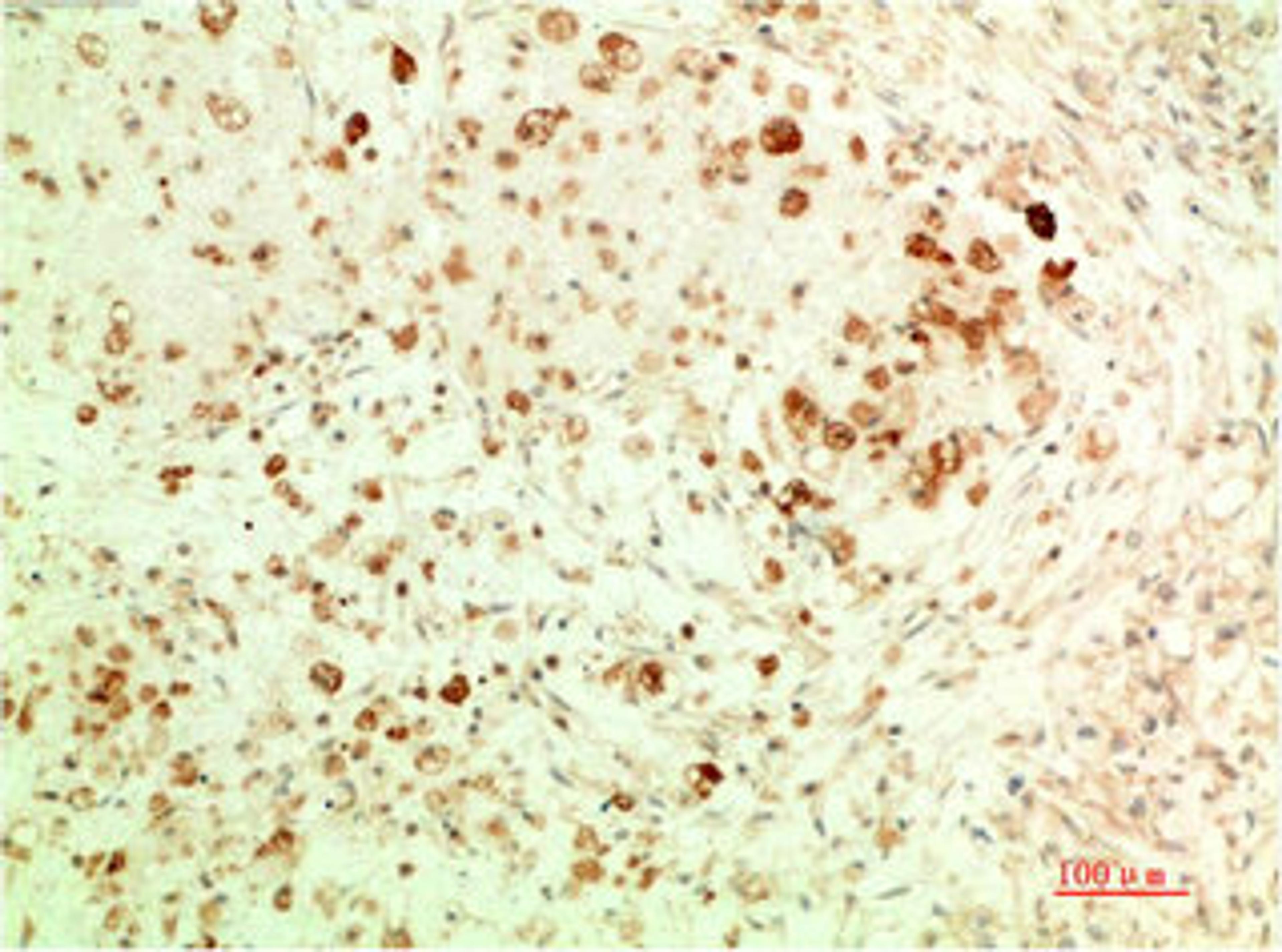 Immunohistochemical analysis of paraffin-embedded Human Ovarian Carcinoma Tissue using ATG5  Mouse mAb diluted at 1:200.