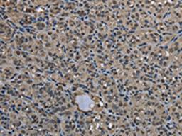 The image on the left is immunohistochemistry of paraffin-embedded Human thyroid cancer tissue using CSB-PA118714(UBB Antibody) at dilution 1/20, on the right is treated with fusion protein. (Original magnification: ×200)