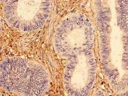 Immunohistochemistry of paraffin-embedded human colon cancer using CSB-PA622780HA01HU at dilution of 1:100