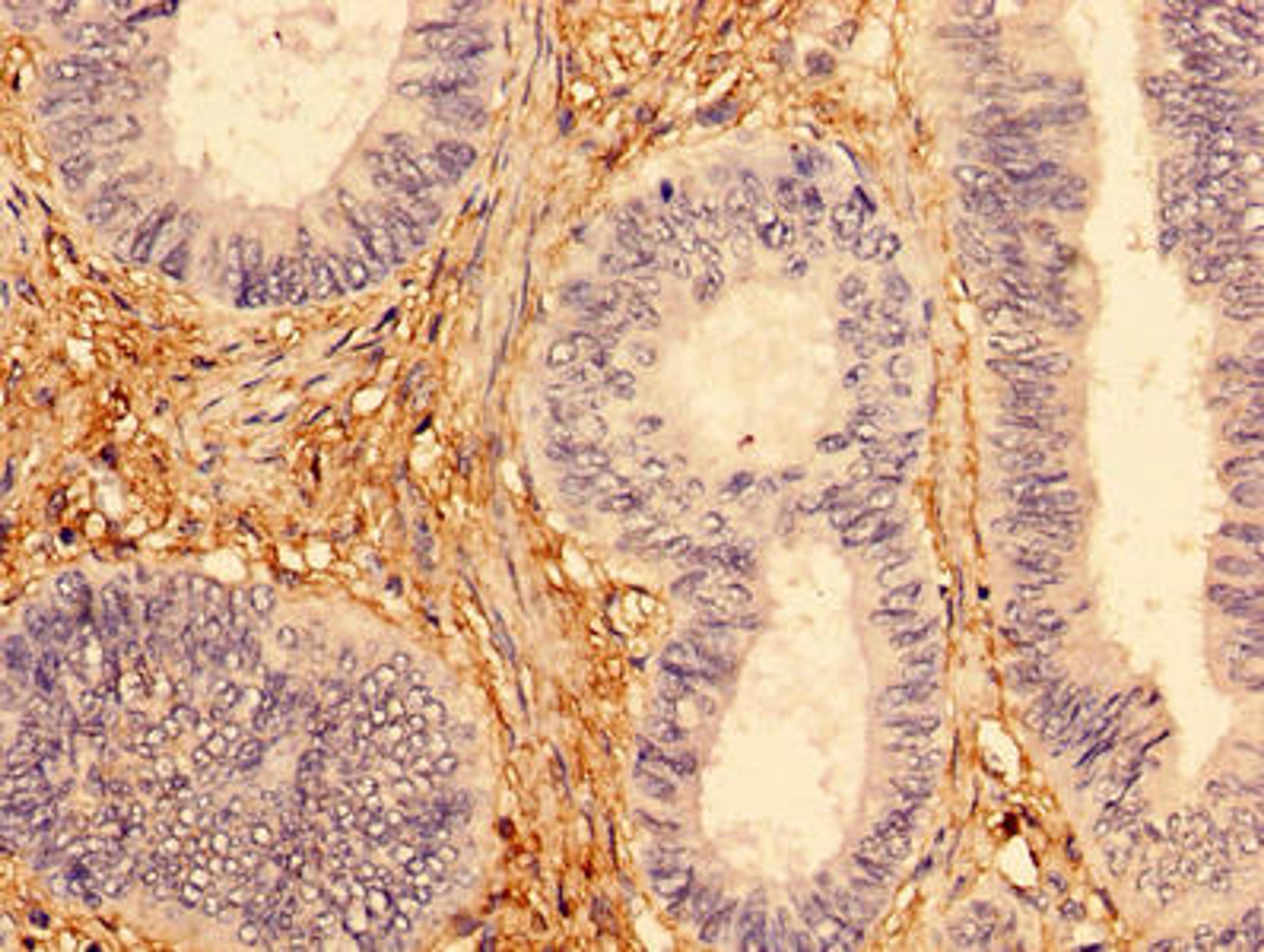 Immunohistochemistry of paraffin-embedded human colon cancer using CSB-PA622780HA01HU at dilution of 1:100