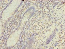 Immunohistochemistry of paraffin-embedded human colon cancer using CSB-PA013748LA01HU at dilution of 1:100