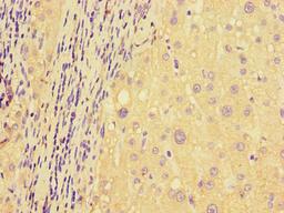 Immunohistochemistry of paraffin-embedded human liver cancer using CSB-PA853399LA01HU at dilution of 1:100