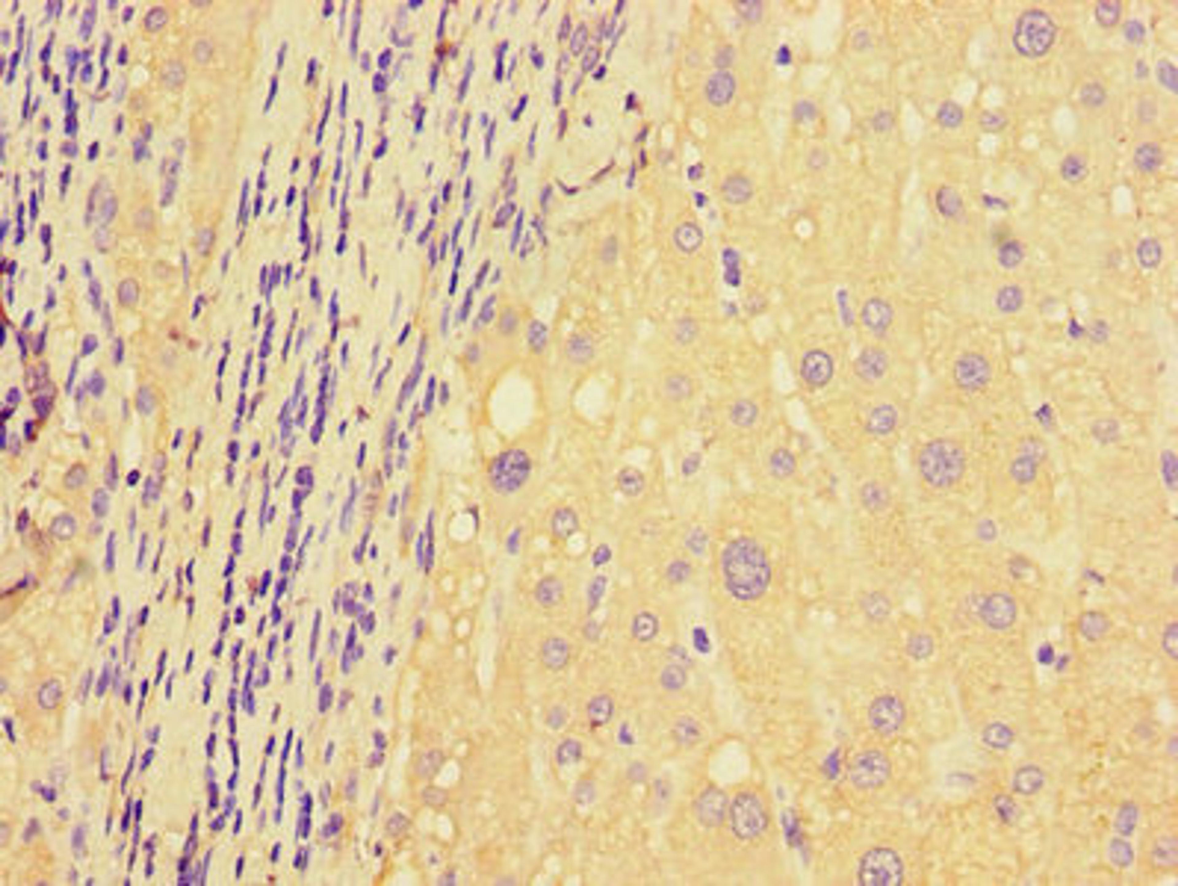 Immunohistochemistry of paraffin-embedded human liver cancer using CSB-PA853399LA01HU at dilution of 1:100