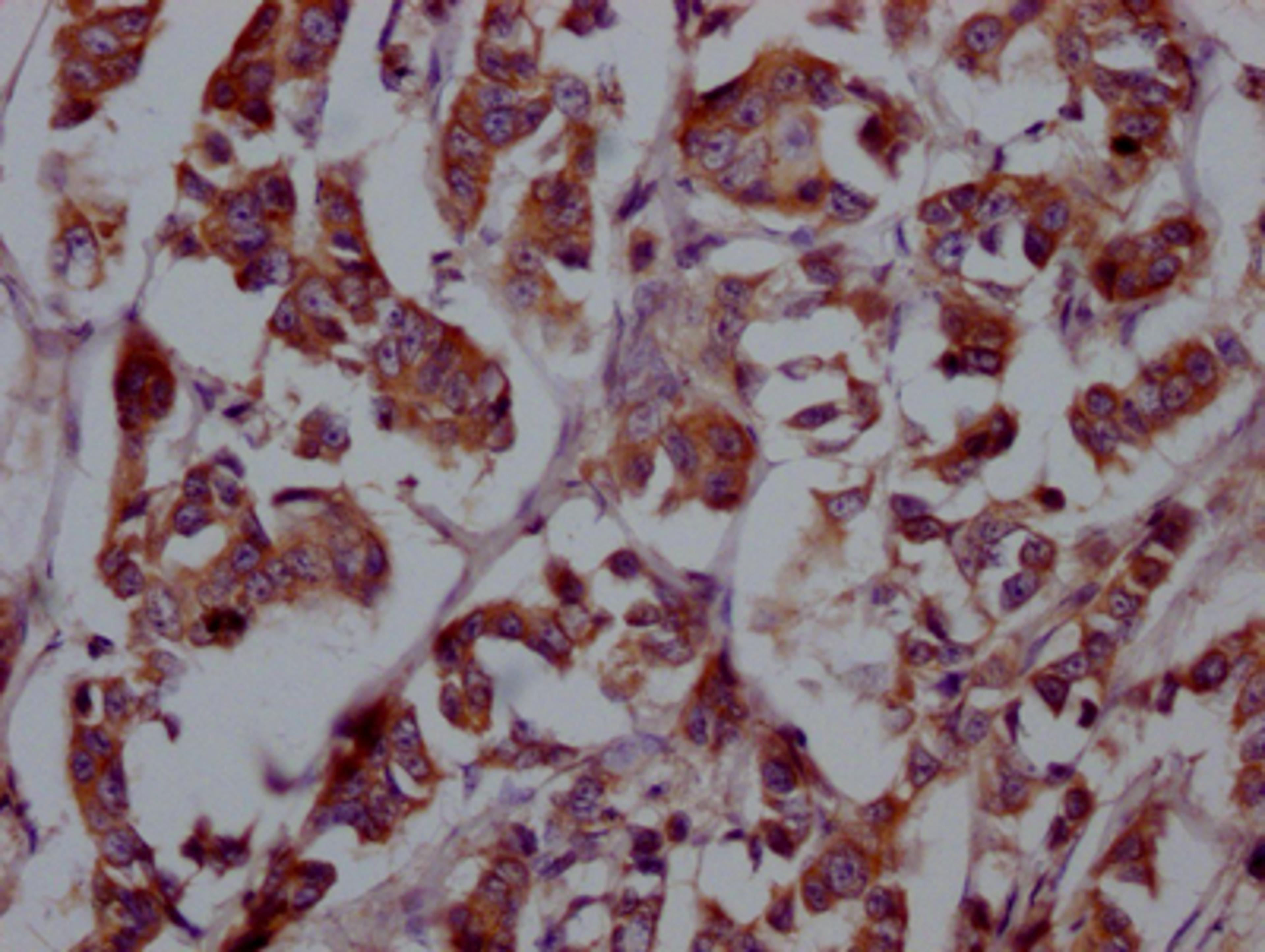 IHC image of CSB-RA927449A0HU diluted at 1:100 and staining in paraffin-embedded human breast cancer performed on a Leica BondTM system. After dewaxing and hydration, antigen retrieval was mediated by high pressure in a citrate buffer (pH 6.0). Section was blocked with 10% normal goat serum 30min at RT. Then primary antibody (1% BSA) was incubated at 4℃ overnight. The primary is detected by a Goat anti-rabbit IgG polymer labeled by HRP and visualized using 0.05% DAB.