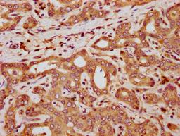 IHC image of CSB-PA621868LA01HU diluted at 1:300 and staining in paraffin-embedded human liver cancer performed on a Leica BondTM system. After dewaxing and hydration, antigen retrieval was mediated by high pressure in a citrate buffer (pH 6.0). Section was blocked with 10% normal goat serum 30min at RT. Then primary antibody (1% BSA) was incubated at 4&deg;C overnight. The primary is detected by a biotinylated secondary antibody and visualized using an HRP conjugated SP system.