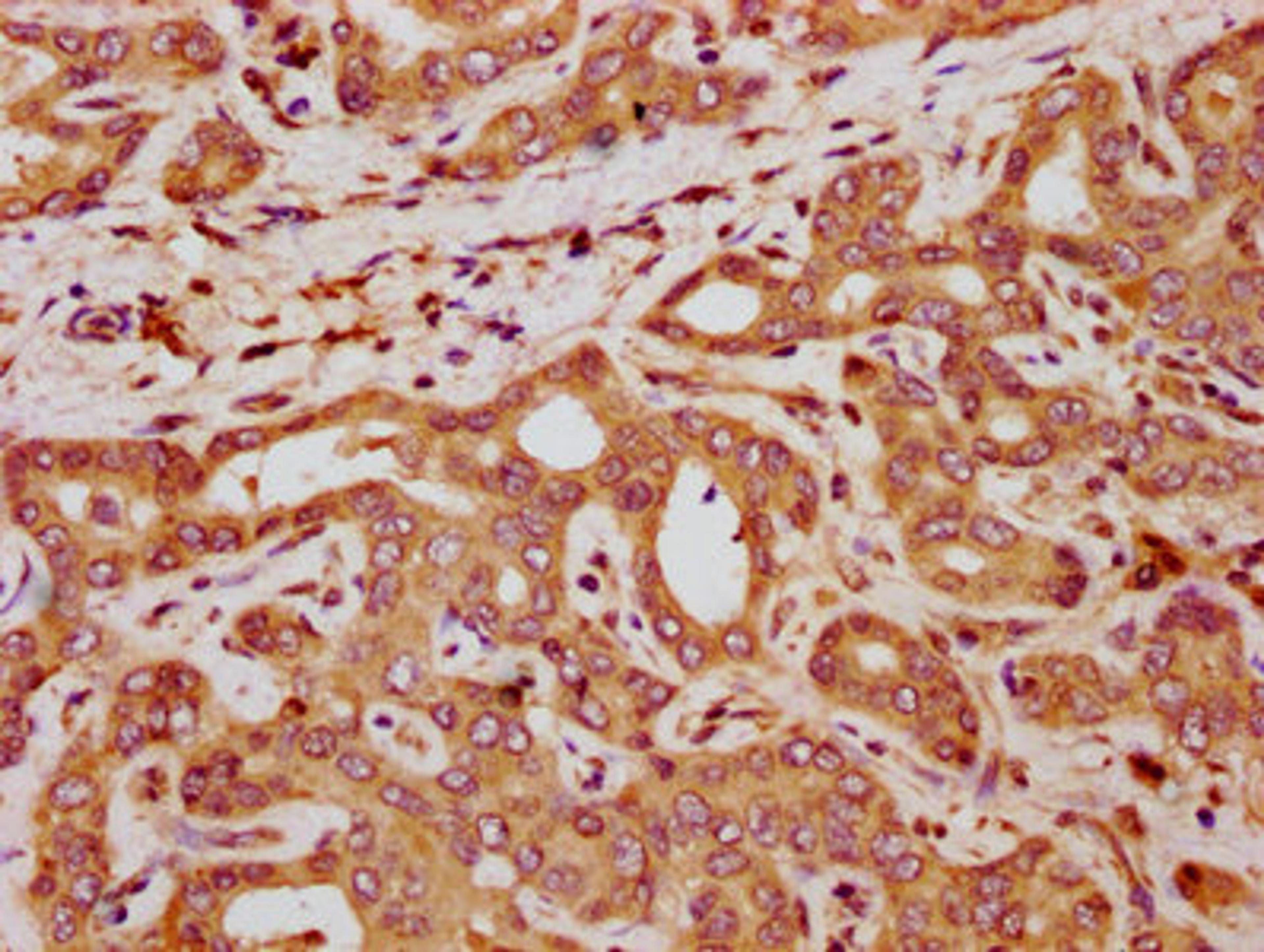 IHC image of CSB-PA621868LA01HU diluted at 1:300 and staining in paraffin-embedded human liver cancer performed on a Leica BondTM system. After dewaxing and hydration, antigen retrieval was mediated by high pressure in a citrate buffer (pH 6.0). Section was blocked with 10% normal goat serum 30min at RT. Then primary antibody (1% BSA) was incubated at 4&deg;C overnight. The primary is detected by a biotinylated secondary antibody and visualized using an HRP conjugated SP system.