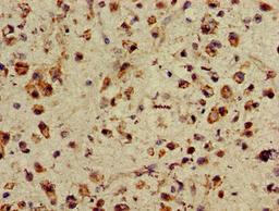 Immunohistochemistry of paraffin-embedded human glioma using CSB-PA865114LA01HU at dilution of 1:100