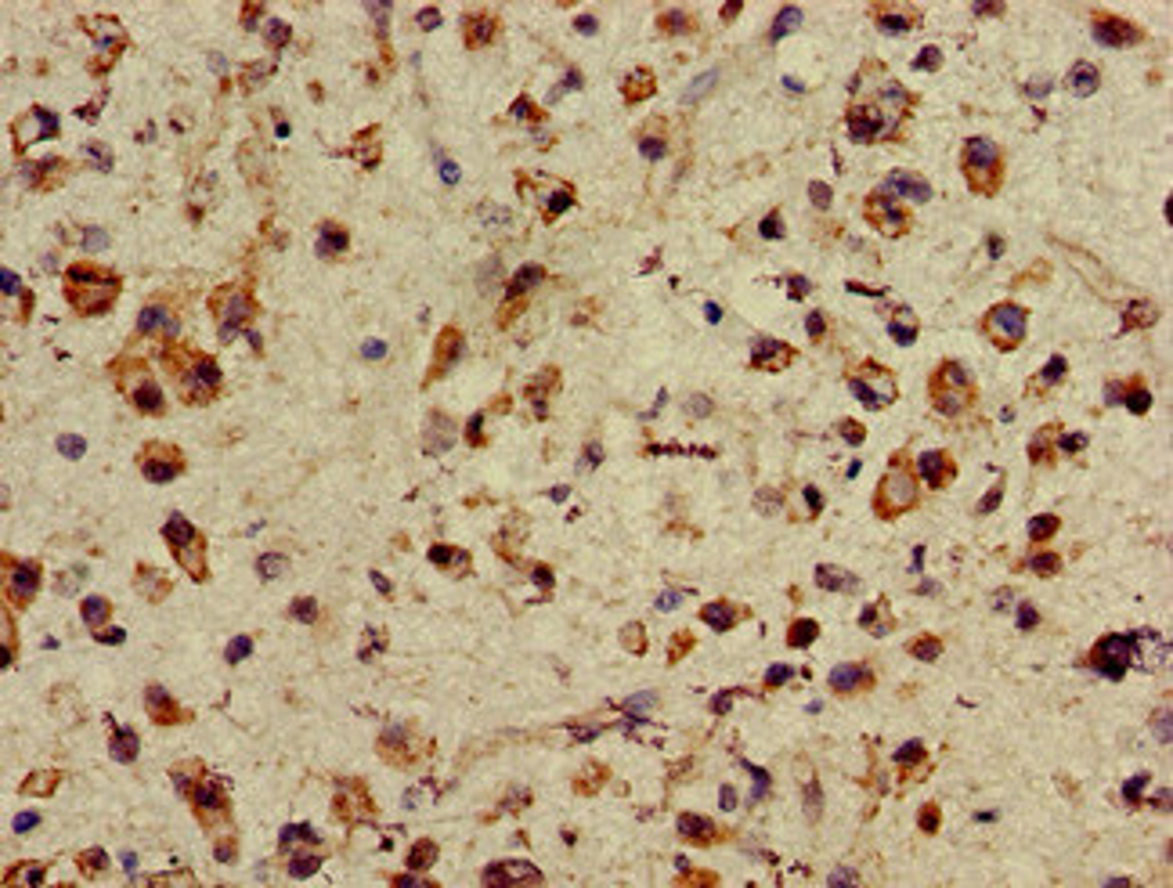 Immunohistochemistry of paraffin-embedded human glioma using CSB-PA865114LA01HU at dilution of 1:100