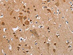 The image on the left is immunohistochemistry of paraffin-embedded Human brain tissue using CSB-PA297945(KRT13 Antibody) at dilution 1/35, on the right is treated with fusion protein. (Original magnification: ×200)