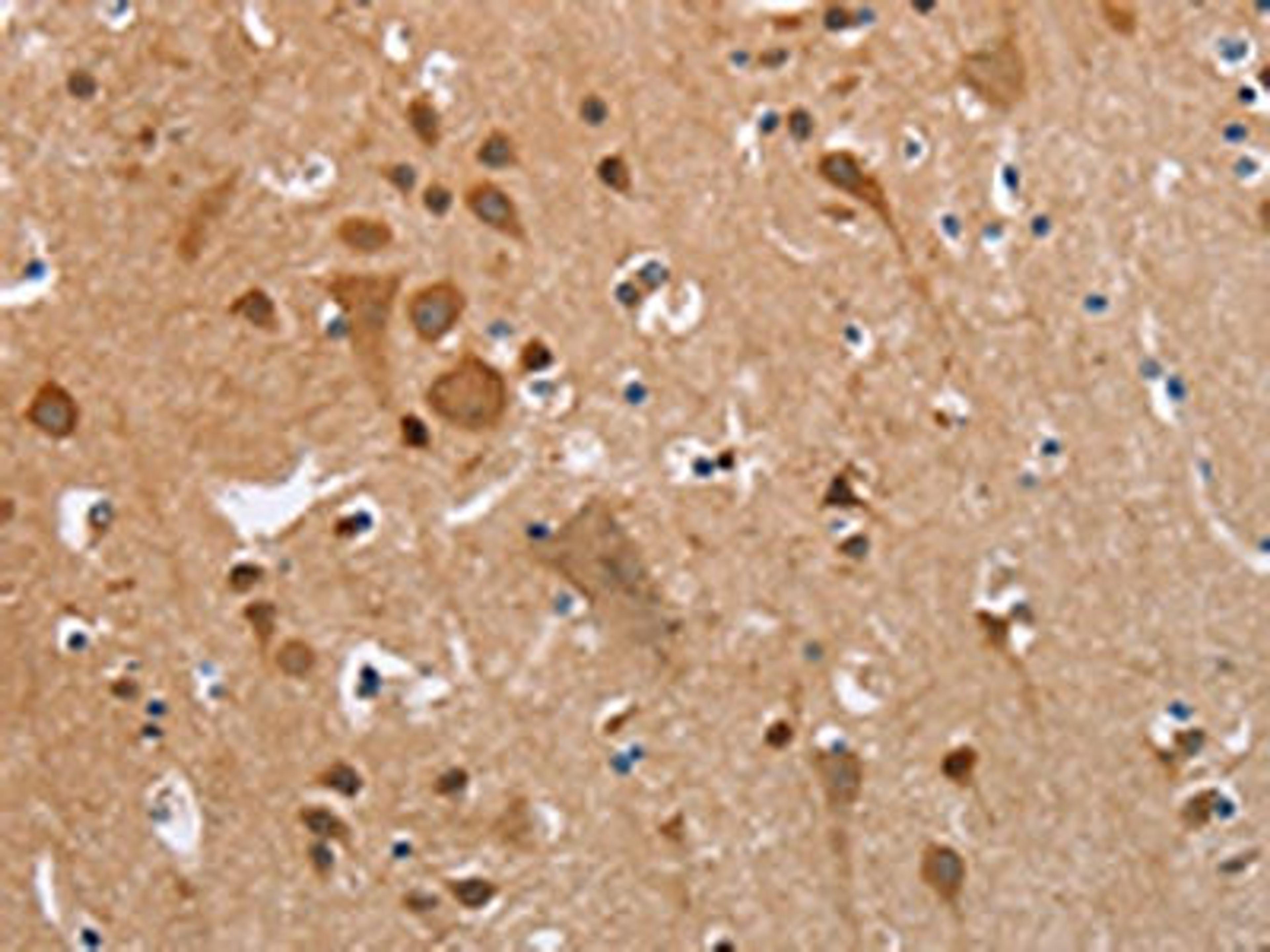 The image on the left is immunohistochemistry of paraffin-embedded Human brain tissue using CSB-PA297945(KRT13 Antibody) at dilution 1/35, on the right is treated with fusion protein. (Original magnification: ×200)