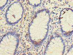 Immunohistochemistry of paraffin-embedded human colon cancer using CSB-PA025146LA01HU at dilution of 1:100