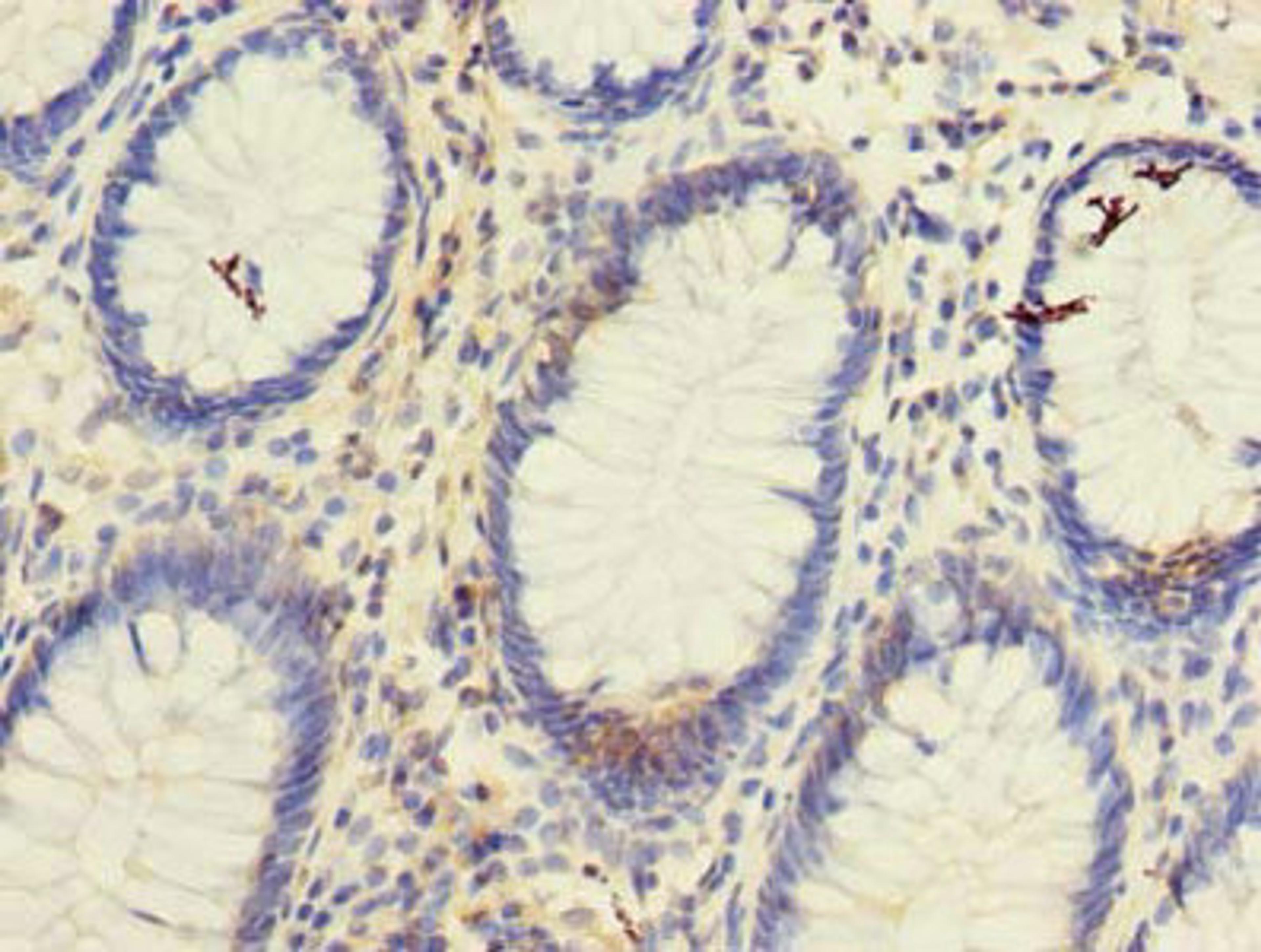 Immunohistochemistry of paraffin-embedded human colon cancer using CSB-PA025146LA01HU at dilution of 1:100