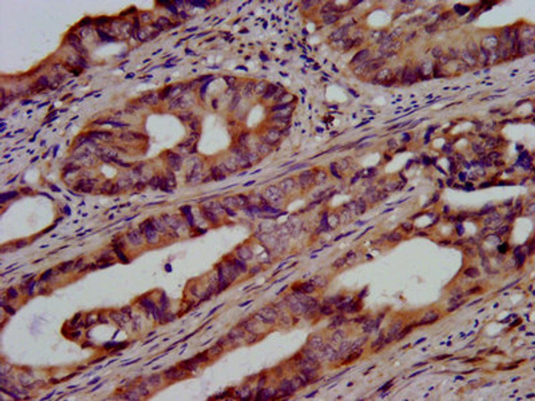 IHC image of CSB-PA025453LA01HU diluted at 1:500 and staining in paraffin-embedded human colon cancer performed on a Leica BondTM system. After dewaxing and hydration, antigen retrieval was mediated by high pressure in a citrate buffer (pH 6.0). Section was blocked with 10% normal goat serum 30min at RT. Then primary antibody (1% BSA) was incubated at 4&deg;C overnight. The primary is detected by a biotinylated secondary antibody and visualized using an HRP conjugated SP system.