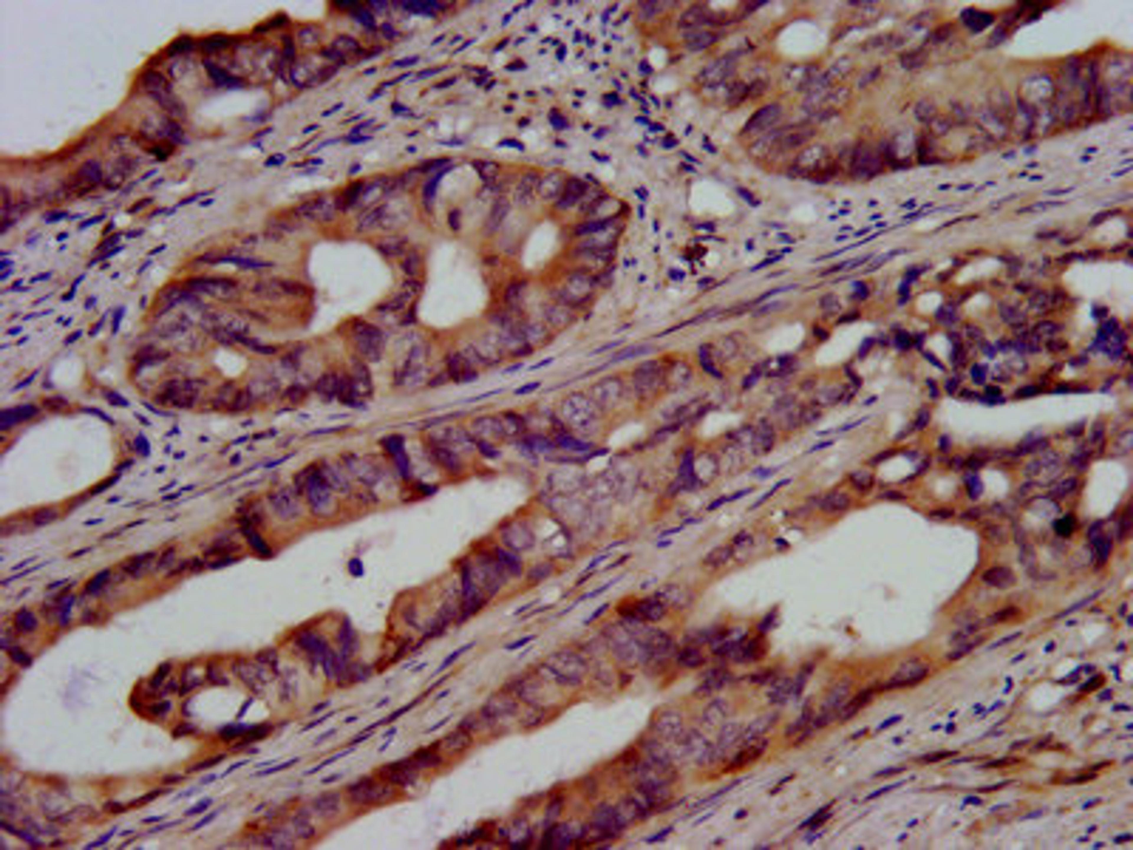 IHC image of CSB-PA025453LA01HU diluted at 1:500 and staining in paraffin-embedded human colon cancer performed on a Leica BondTM system. After dewaxing and hydration, antigen retrieval was mediated by high pressure in a citrate buffer (pH 6.0). Section was blocked with 10% normal goat serum 30min at RT. Then primary antibody (1% BSA) was incubated at 4&deg;C overnight. The primary is detected by a biotinylated secondary antibody and visualized using an HRP conjugated SP system.