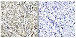 Immunohistochemical analysis of paraffin-embedded human breast carcinoma tissue using NFkB-p65(Phospho-Ser529) Antibody(left) or the same antibody preincubated with blocking peptide(right).