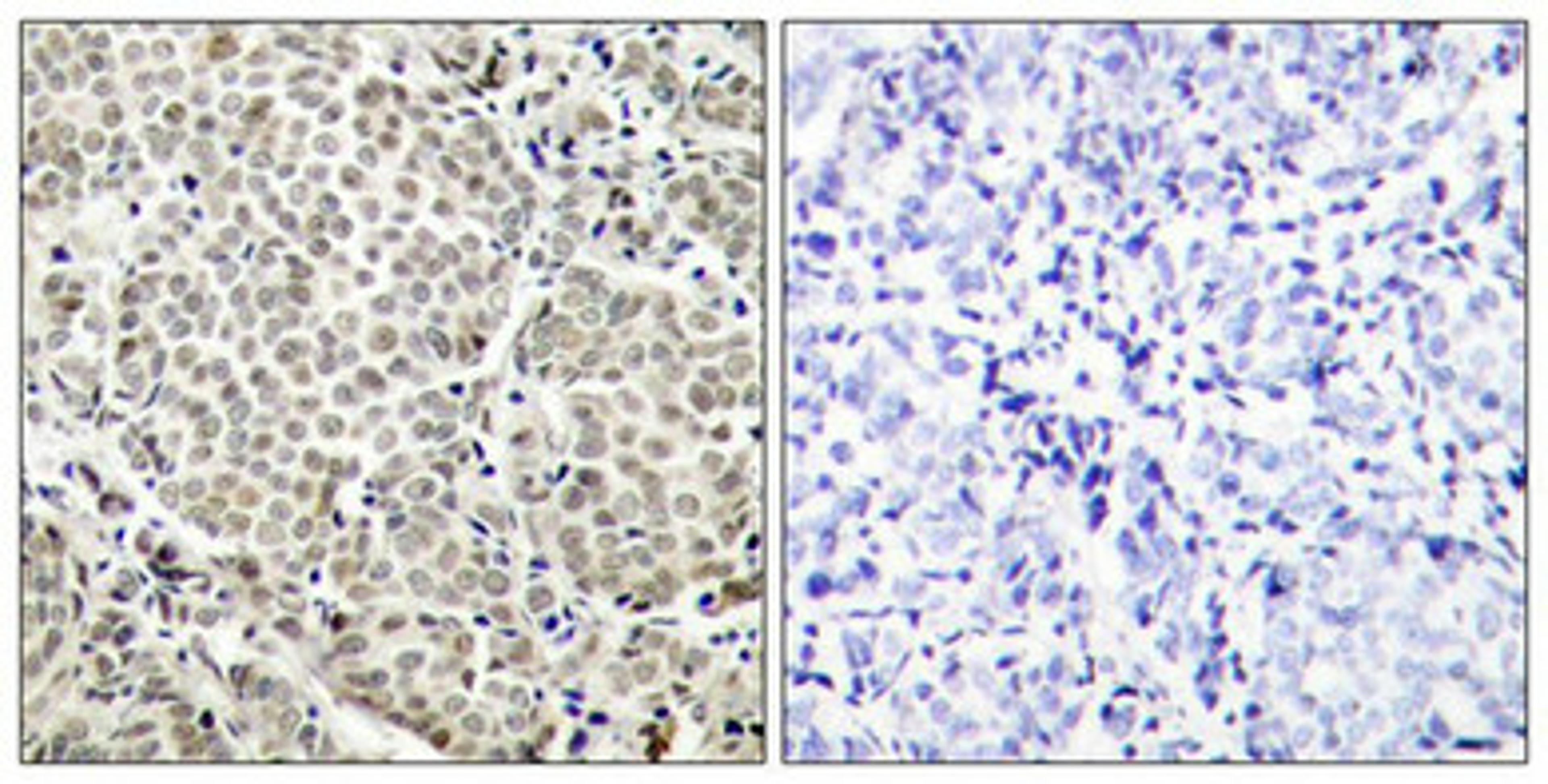 Immunohistochemical analysis of paraffin-embedded human breast carcinoma tissue using NFkB-p65(Phospho-Ser529) Antibody(left) or the same antibody preincubated with blocking peptide(right).