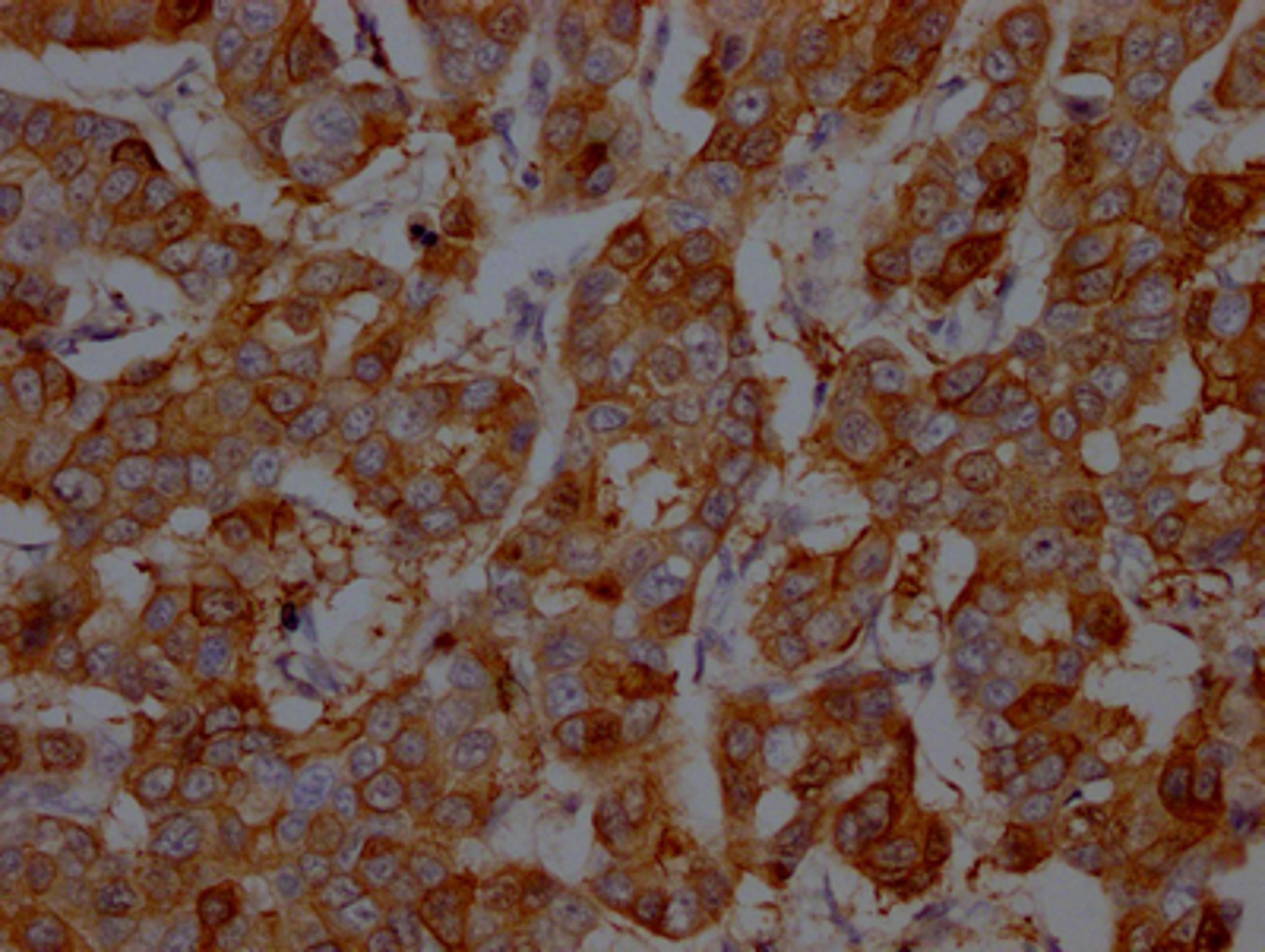IHC image of CSB-RA958800A0HU diluted at 1:100 and staining in paraffin-embedded human breast cancer performed on a Leica BondTM system. After dewaxing and hydration, antigen retrieval was mediated by high pressure in a citrate buffer (pH 6.0). Section was blocked with 10% normal goat serum 30min at RT. Then primary antibody (1% BSA) was incubated at 4℃ overnight. The primary is detected by a Goat anti-rabbit IgG polymer labeled by HRP and visualized using 0.05% DAB.