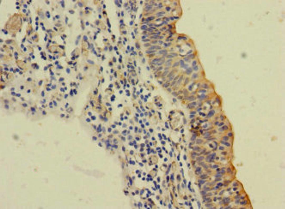 Immunohistochemistry of paraffin-embedded human bladder cancer using CSB-PA875657LA01HU at dilution of 1:100