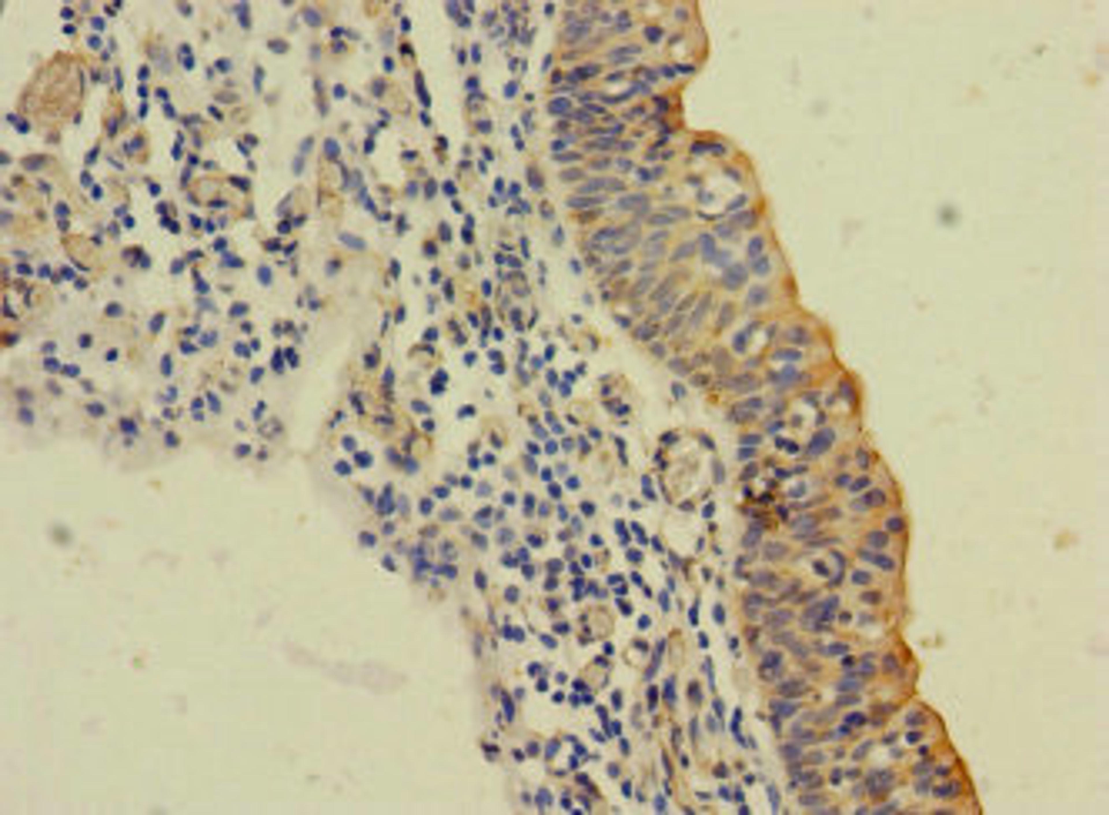 Immunohistochemistry of paraffin-embedded human bladder cancer using CSB-PA875657LA01HU at dilution of 1:100