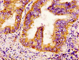 IHC image of CSB-PA613605LA01HU diluted at 1:300 and staining in paraffin-embedded human endometrial cancer performed on a Leica BondTM system. After dewaxing and hydration, antigen retrieval was mediated by high pressure in a citrate buffer (pH 6.0). Section was blocked with 10% normal goat serum 30min at RT. Then primary antibody (1% BSA) was incubated at 4&deg;C overnight. The primary is detected by a biotinylated secondary antibody and visualized using an HRP conjugated SP system.