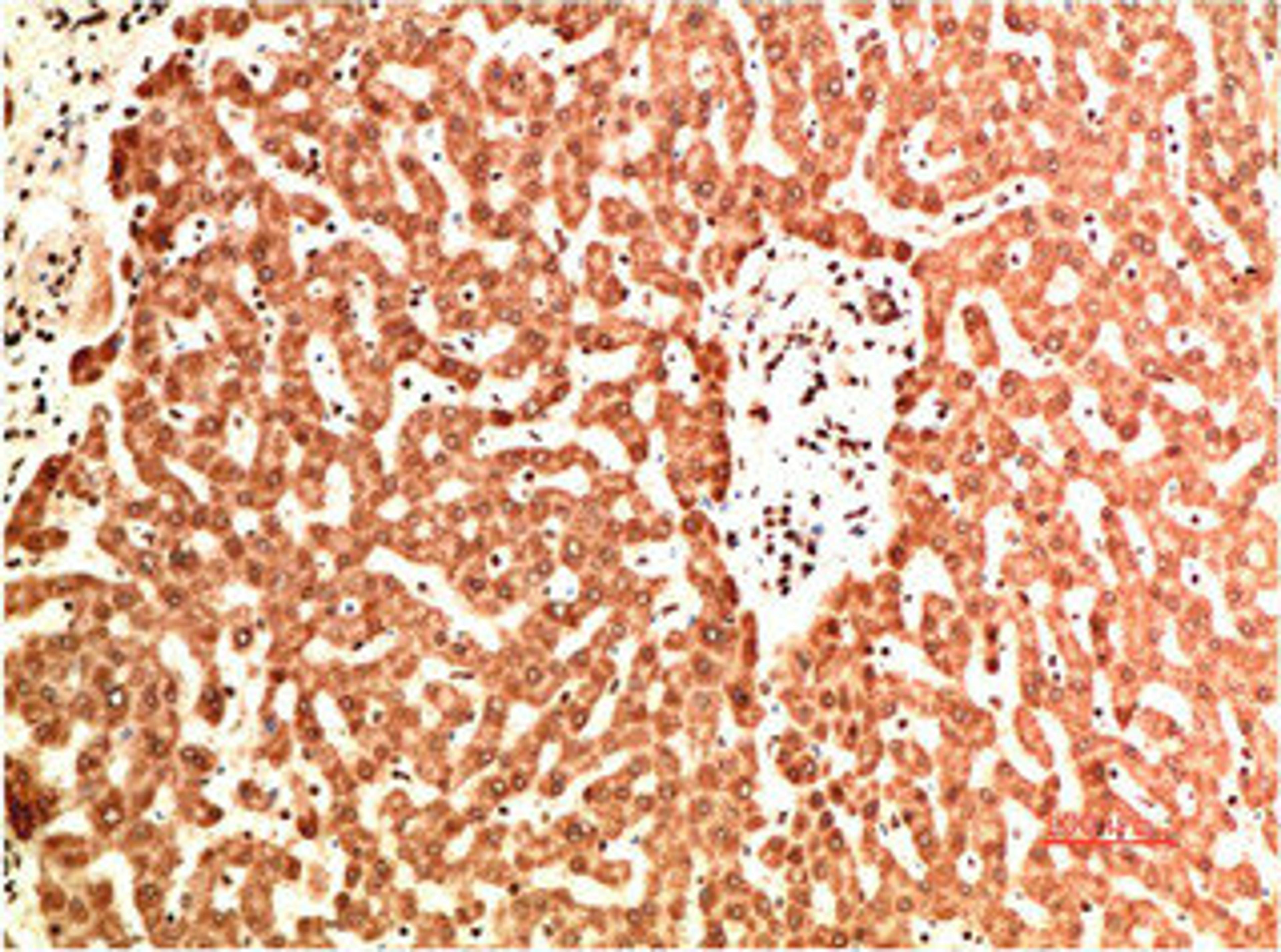 Immunohistochemical analysis of paraffin-embedded Human Liver Carcinoma Tissue using Collagen IV Mouse mAb diluted at 1:200.