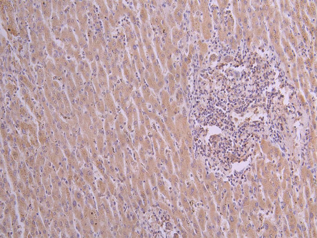 IHC image of CSB-RA025833MA1HU diluted at 1:50 and staining in paraffin-embedded human liver cancer performed on a Leica BondTM system. After dewaxing and hydration, antigen retrieval was mediated by high pressure in a citrate buffer (pH 6.0). Section was blocked with 10% normal goat serum 30min at RT. Then primary antibody (1% BSA) was incubated at 4°C overnight. The primary is detected by a Goat anti-human polymer IgG labeled by HRP and visualized using 0.05% DAB.