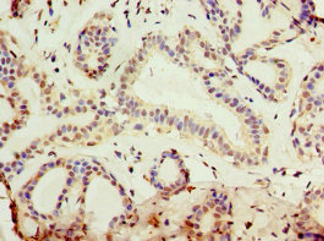 Immunohistochemistry of paraffin-embedded human breast cancer using CSB-PA012393DSR2HU at dilution of 1:100