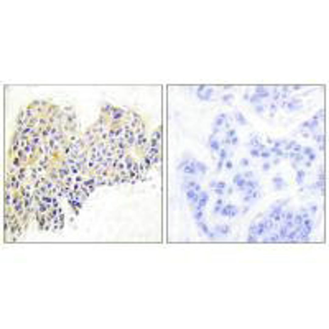 Immunohistochemical analysis of paraffin-embedded human breast carcinoma tissue using HSP90B (Ab-254) antibody.