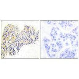 Immunohistochemical analysis of paraffin-embedded human breast carcinoma tissue using HSP90B (Ab-254) antibody.