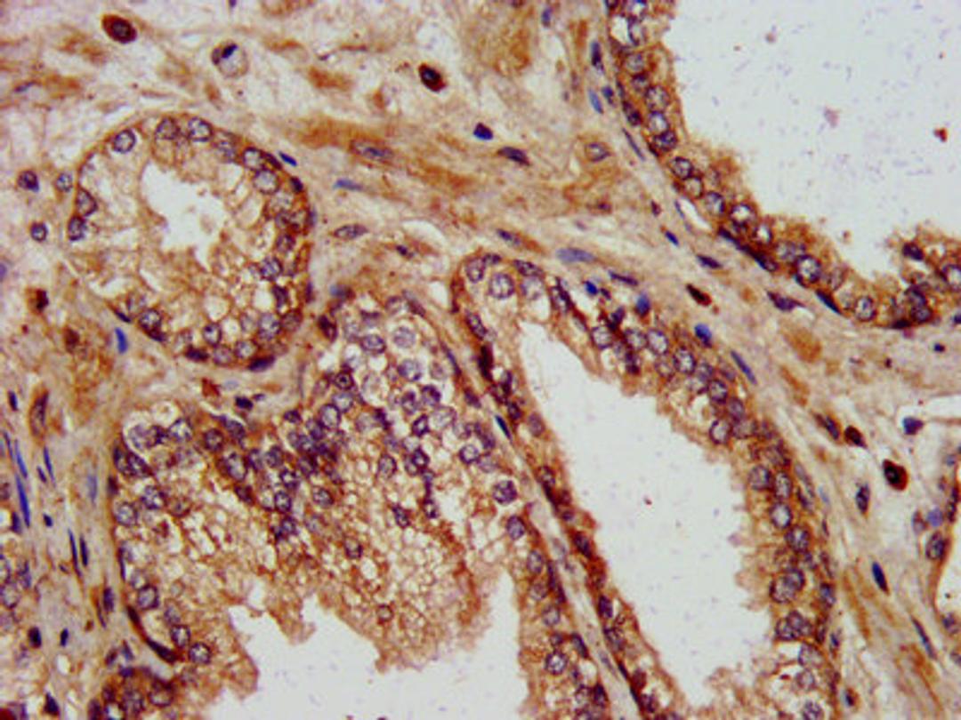 IHC image of CSB-PA873625LA01HU diluted at 1:400 and staining in paraffin-embedded human prostate cancer performed on a Leica BondTM system.