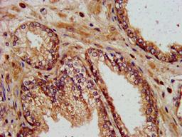 IHC image of CSB-PA873625LA01HU diluted at 1:400 and staining in paraffin-embedded human prostate cancer performed on a Leica BondTM system.