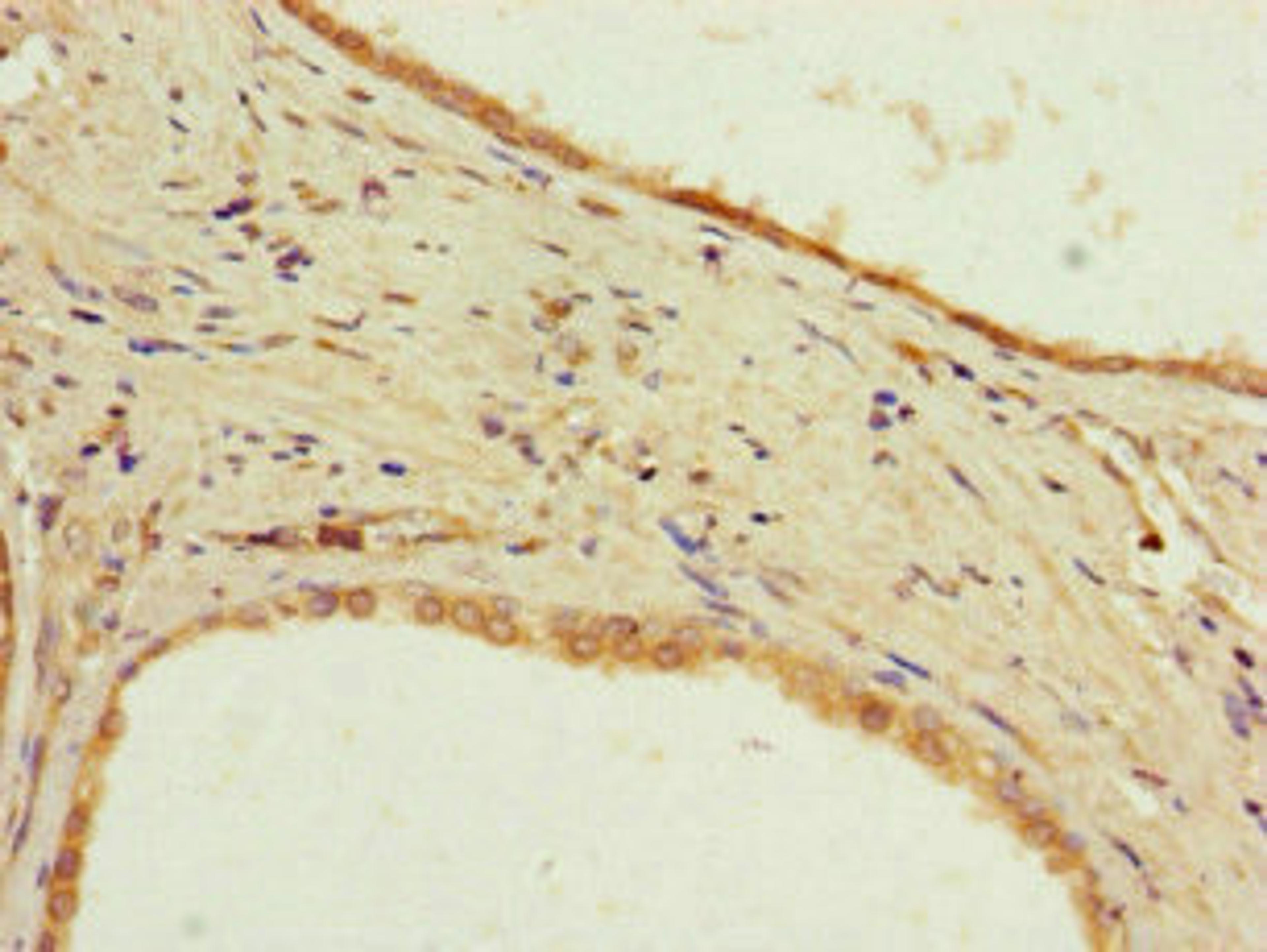 Immunohistochemistry of paraffin-embedded human prostate cancer using CSB-PA727750LA01HU at dilution of 1:100