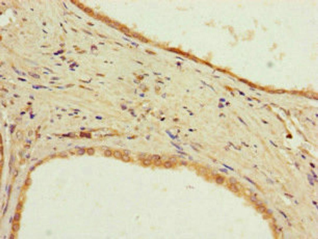 Immunohistochemistry of paraffin-embedded human prostate cancer using CSB-PA727750LA01HU at dilution of 1:100
