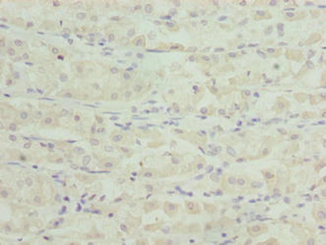 Immunohistochemistry of paraffin-embedded human gastric cancer using CSB-PA768209LA01HU at dilution of 1:100